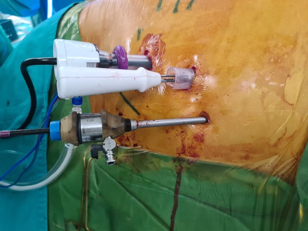 Θερμοκαταστροφή (RF ablation) όγκων ήπατος